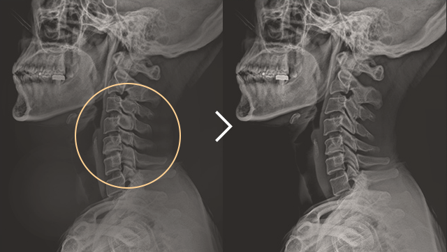 일자목 치료 전후사진