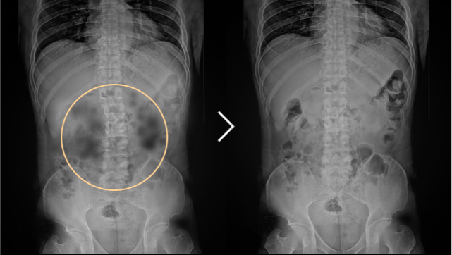 척추측만증 치료 전후사진