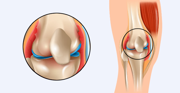 류마티스 관절염