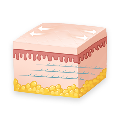 STEP 3 무균성 염증반응을 유도하여 주변 콜라겐 섬유의 재생을 촉진